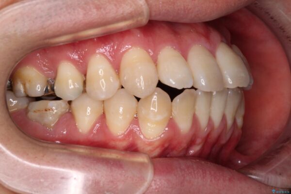 口元の突出感を改善!目立ちにくいワイヤー矯正で自信を持てる自然な横顔に 治療前画像