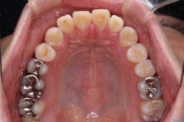 口元の突出感を改善!目立ちにくいワイヤー矯正で自信を持てる自然な横顔に 治療前画像