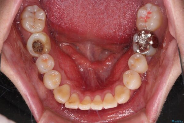 口元の突出感を改善!目立ちにくいワイヤー矯正で自信を持てる自然な横顔に 治療前画像