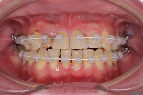 割れてしまった奥歯とデコボコの前歯　矯正治療とインプラント治療 治療途中画像
