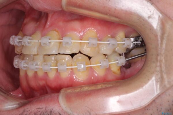 割れてしまった奥歯とデコボコの前歯　矯正治療とインプラント治療 治療途中画像