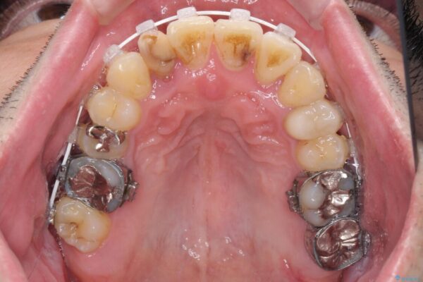 割れてしまった奥歯とデコボコの前歯　矯正治療とインプラント治療 治療途中画像