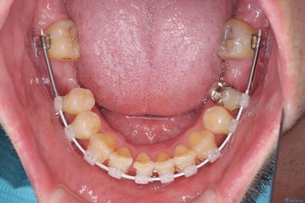 割れてしまった奥歯とデコボコの前歯　矯正治療とインプラント治療 治療途中画像