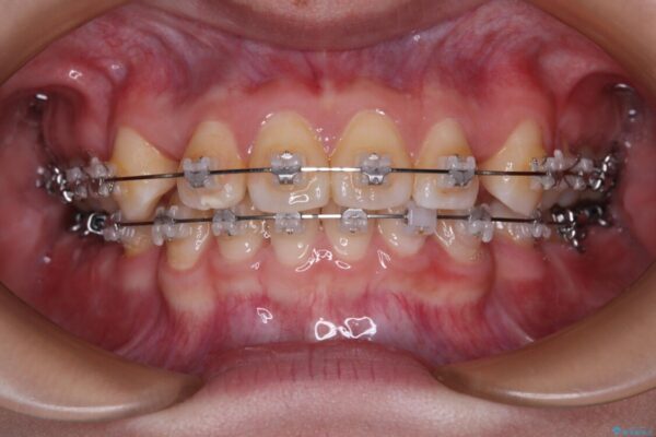 転勤でも安心して治療継続　抜歯スペース閉鎖と深い噛み合わせ改善のワイヤー矯正 ビフォー