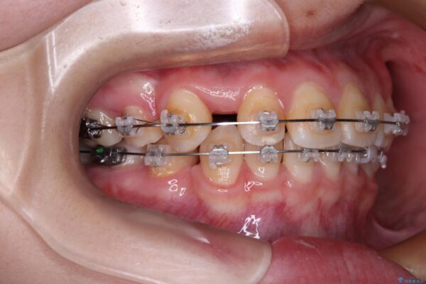 転勤でも安心して治療継続　抜歯スペース閉鎖と深い噛み合わせ改善のワイヤー矯正 治療前画像