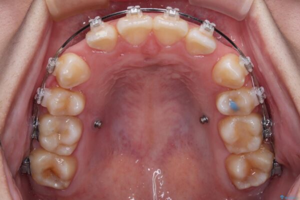 転勤でも安心して治療継続　抜歯スペース閉鎖と深い噛み合わせ改善のワイヤー矯正 治療前画像