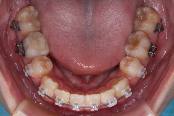 転勤でも安心して治療継続　抜歯スペース閉鎖と深い噛み合わせ改善のワイヤー矯正 治療前画像