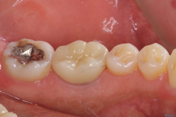 むし歯で歯茎から血が出てくる　オールセラミッククラウンでの補綴治療 治療後画像