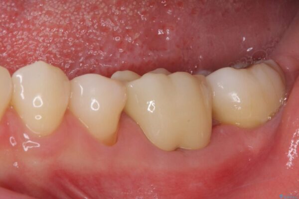 むし歯で歯茎から血が出てくる　オールセラミッククラウンでの補綴治療 治療後画像