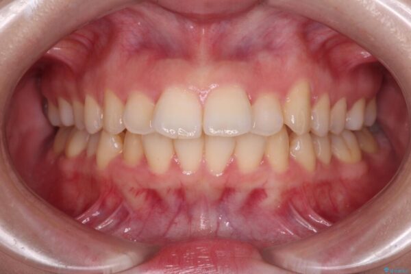 【モニター】口が閉じられない　ワイヤー装置での抜歯矯正 治療前画像