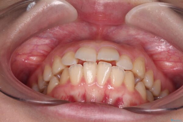 【モニター】口が閉じられない　ワイヤー装置での抜歯矯正 治療前画像