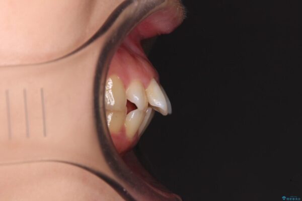 【モニター】口が閉じられない　ワイヤー装置での抜歯矯正 治療前画像