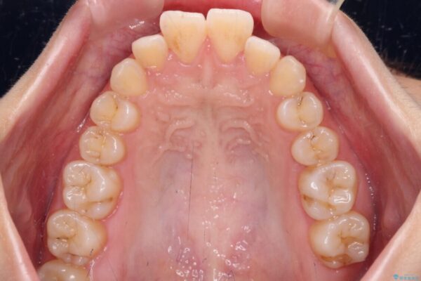 【モニター】口が閉じられない　ワイヤー装置での抜歯矯正 治療前画像