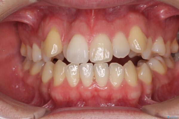 左右の八重歯が気になる　ワイヤー装置での咬み合わせ改善 治療前画像