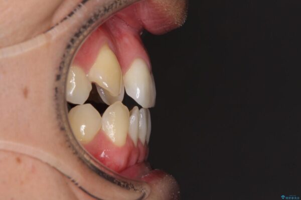 左右の八重歯が気になる　ワイヤー装置での咬み合わせ改善 治療前画像