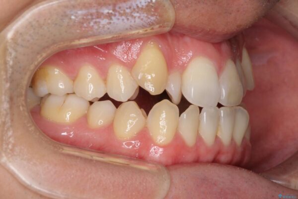 左右の八重歯が気になる　ワイヤー装置での咬み合わせ改善 治療前画像