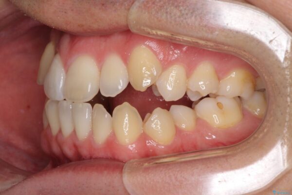 左右の八重歯が気になる　ワイヤー装置での咬み合わせ改善 治療前画像