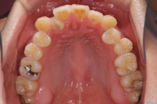 左右の八重歯が気になる　ワイヤー装置での咬み合わせ改善 治療前画像