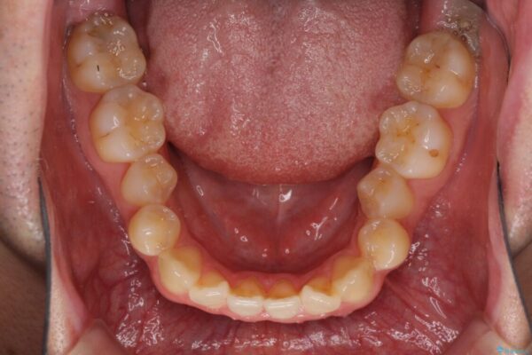 左右の八重歯が気になる　ワイヤー装置での咬み合わせ改善 治療前画像