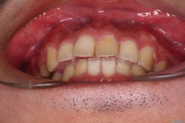後戻りでデコボコの前歯　インビザライン矯正治療 治療途中画像