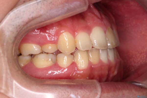 後戻りでデコボコの前歯　インビザライン矯正治療 治療途中画像
