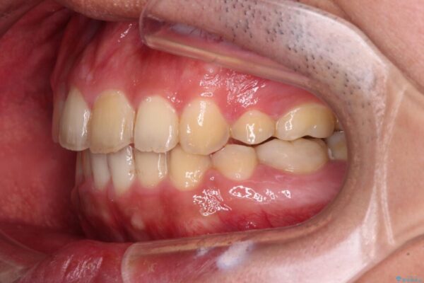 後戻りでデコボコの前歯　インビザライン矯正治療 治療途中画像