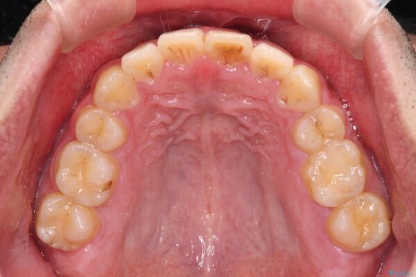 後戻りでデコボコの前歯　インビザライン矯正治療 治療途中画像