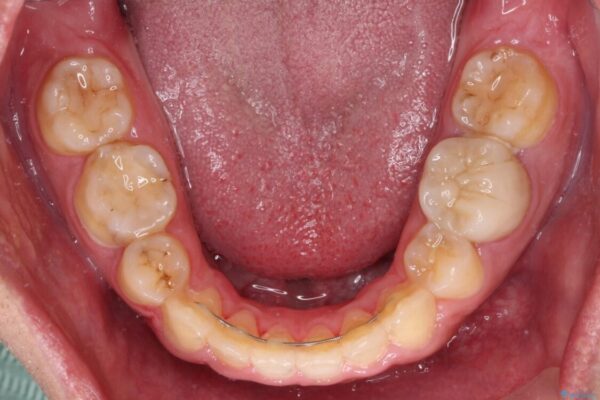 後戻りでデコボコの前歯　インビザライン矯正治療 治療途中画像