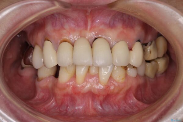 放置したインプラントとインビザライン　全顎リカバリー治療 治療前画像