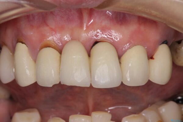 放置したインプラントとインビザライン　全顎リカバリー治療 治療前画像