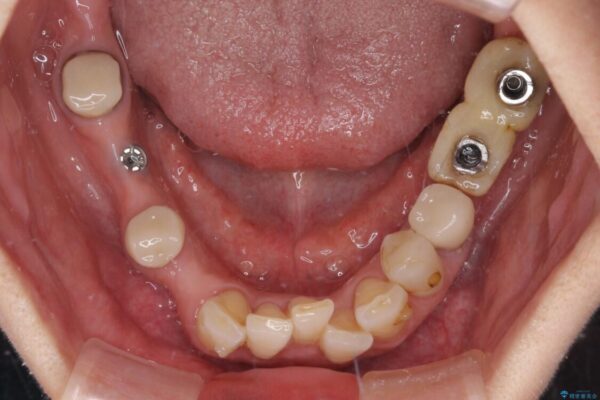 放置したインプラントとインビザライン　全顎リカバリー治療 治療前画像