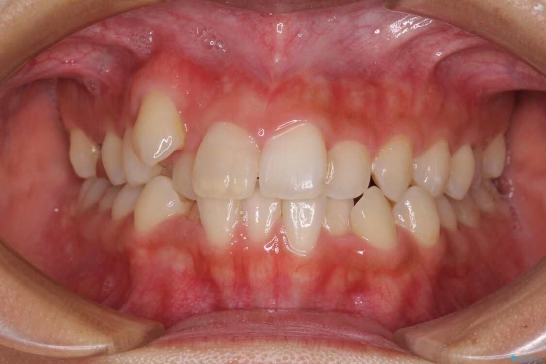 気になる八重歯　目立ちにくいハーフリンガルでの抜歯矯正 治療前