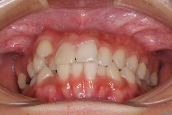 気になる八重歯　目立ちにくいハーフリンガルでの抜歯矯正 治療前画像