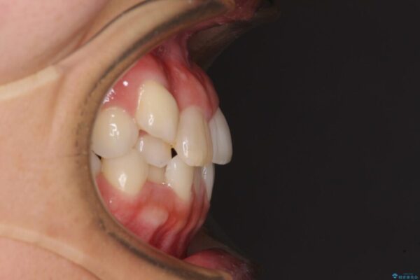 気になる八重歯　目立ちにくいハーフリンガルでの抜歯矯正 治療前画像