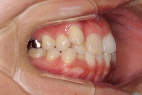 気になる八重歯　目立ちにくいハーフリンガルでの抜歯矯正 治療前画像