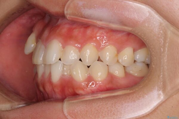 気になる八重歯　目立ちにくいハーフリンガルでの抜歯矯正 治療前画像