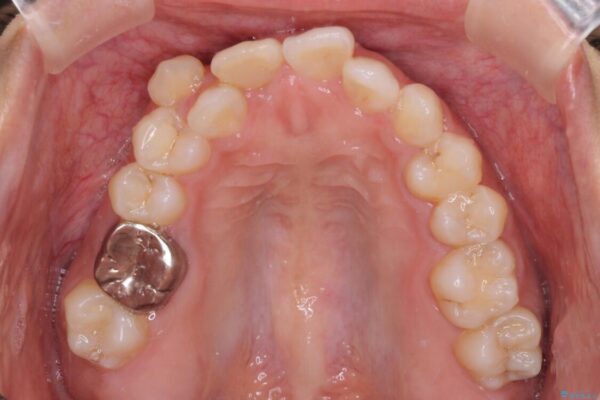 気になる八重歯　目立ちにくいハーフリンガルでの抜歯矯正 治療前画像