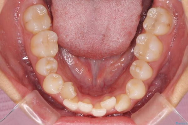 気になる八重歯　目立ちにくいハーフリンガルでの抜歯矯正 治療前画像