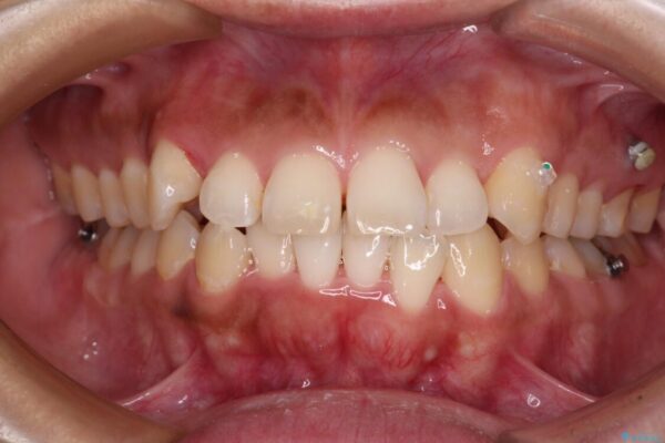 【モニター】カリエール・ディスタライザーを併用した八重歯のインビザライン矯正 治療途中画像