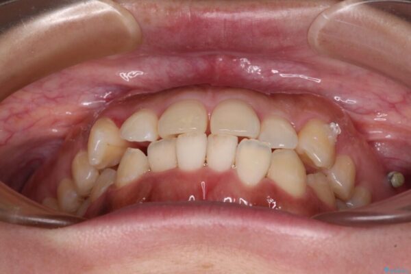 【モニター】カリエール・ディスタライザーを併用した八重歯のインビザライン矯正 治療途中画像