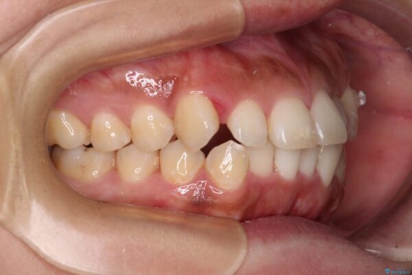 【モニター】カリエール・ディスタライザーを併用した八重歯のインビザライン矯正 治療途中画像