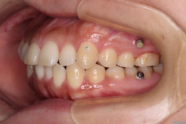 【モニター】カリエール・ディスタライザーを併用した八重歯のインビザライン矯正 治療途中画像