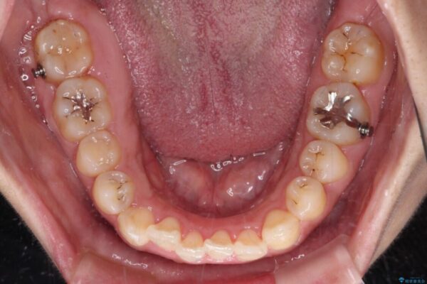 【モニター】カリエール・ディスタライザーを併用した八重歯のインビザライン矯正 治療途中画像