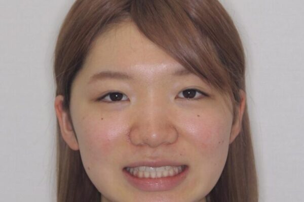 【モニター】短期間で終わりたい　ワイヤー装置での非抜歯矯正 治療後画像