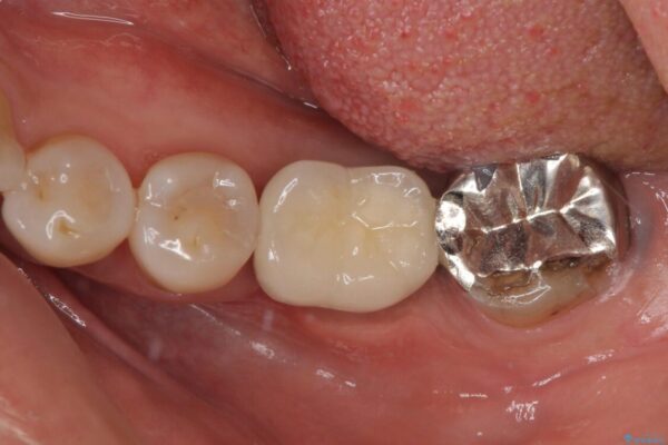 しみる奥歯　オールセラミッククラウンによる補綴治療 ビフォー