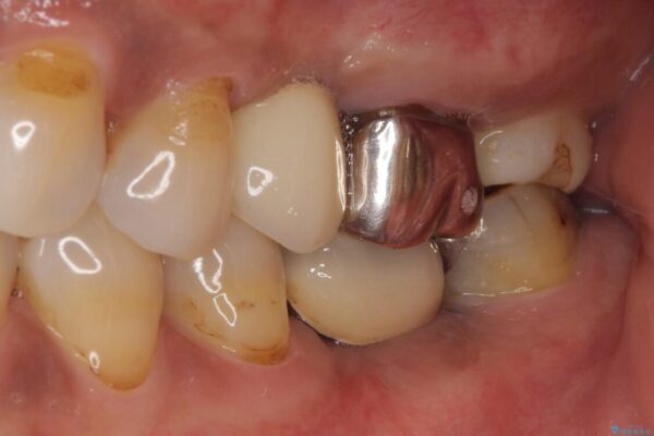 しみる奥歯　オールセラミッククラウンによる補綴治療 治療前画像