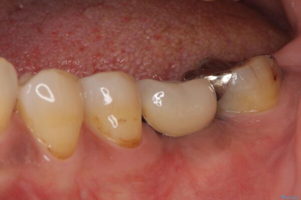 しみる奥歯　オールセラミッククラウンによる補綴治療 治療前画像