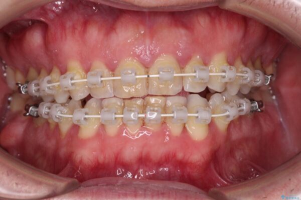 前歯でものを噛みきりたい　目立たない装置でのワイヤー矯正 治療途中画像
