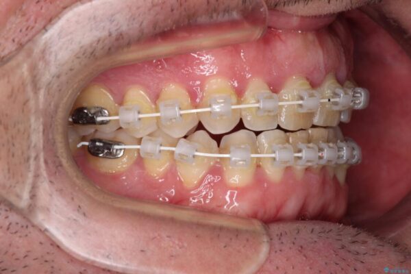 前歯でものを噛みきりたい　目立たない装置でのワイヤー矯正 治療途中画像
