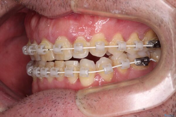 前歯でものを噛みきりたい　目立たない装置でのワイヤー矯正 治療途中画像